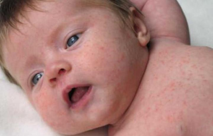 Les boutons de chaleur chez le bébé
