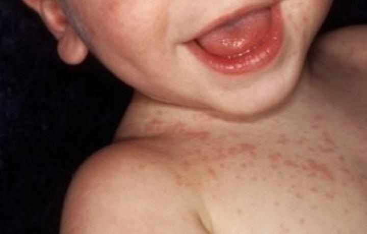 Les boutons de la rubéole chez le bébé